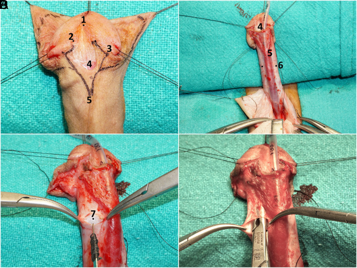 Surgical Technique of Glans Wings Creation with Preservation of Glanular Vascular Arcade and Creating Flaps for Tension-Free Glansplasty in Hypospadias Repair.