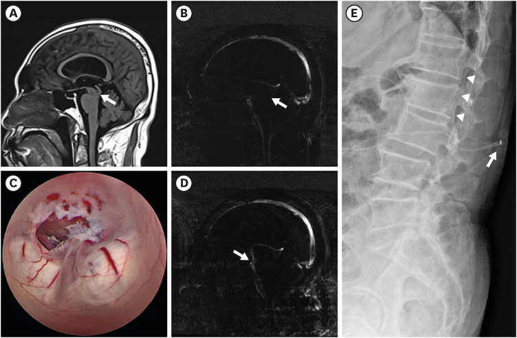 Combined Endoscopic Third Ventriculostomy and Lumboperitoneal Shunt Surgery in an Elderly Patient With Complex Hydrocephalus: Mixture of Late-onset Obstructive and Communicating Hydrocephaluses.