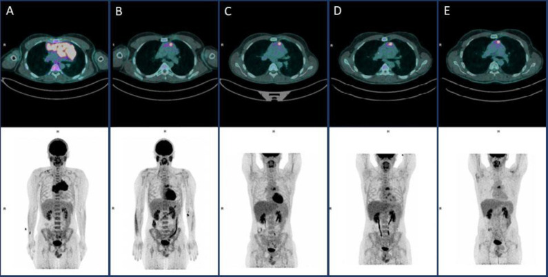 Misinterpretation of an inflammatory FDG uptake in a patient treated for Hodgkin lymphoma: a case report.