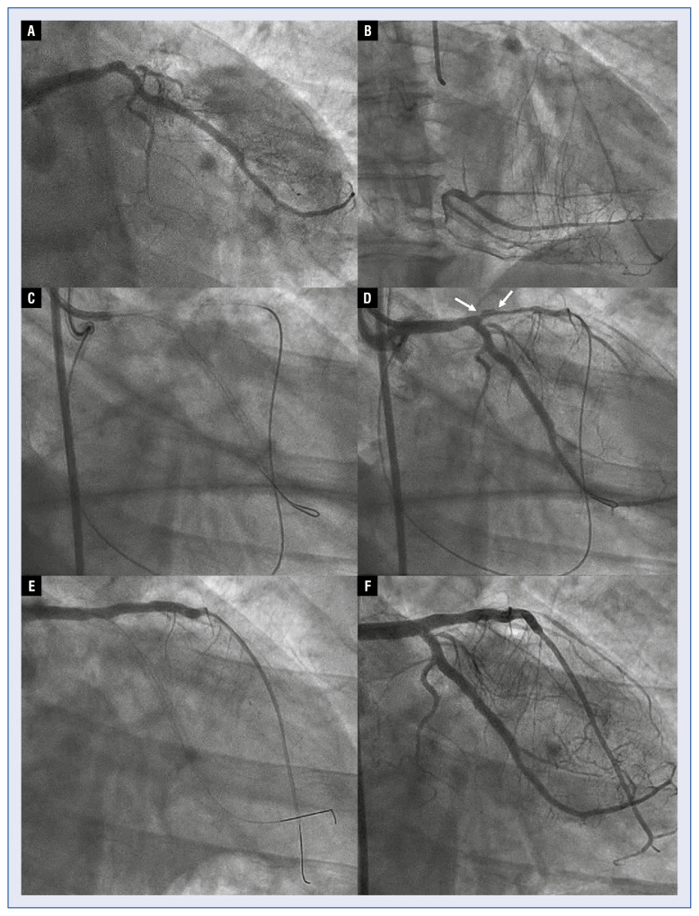 Subintimal shift as mechanism for side-branch occlusion in percutaneous treatment of chronic total occlusions with bifurcation lesions.