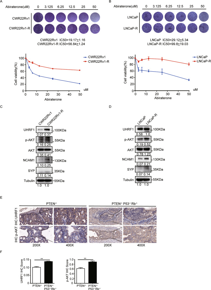 AKT1 regulates UHRF1 protein stability and promotes the resistance to abiraterone in prostate cancer.