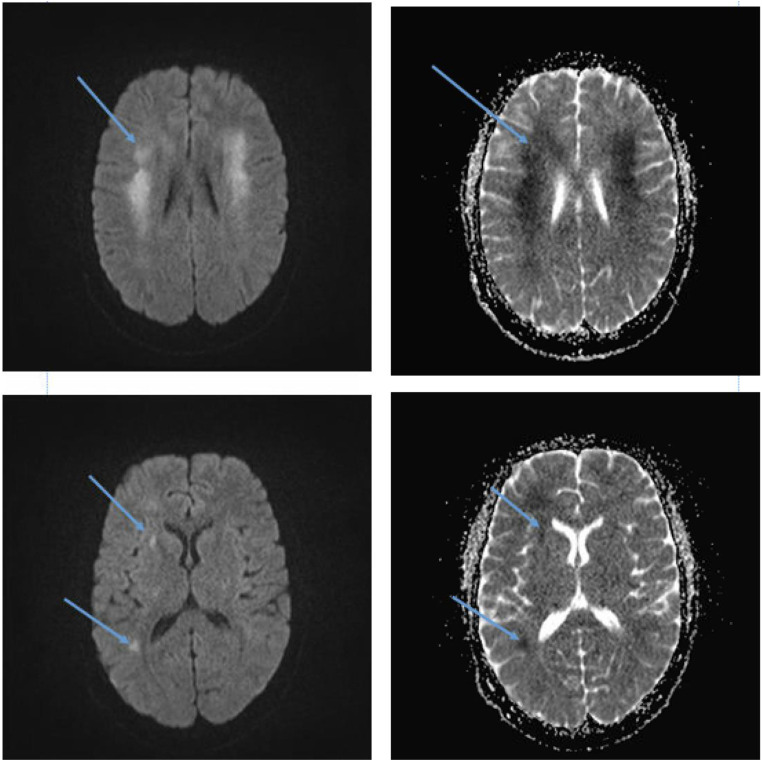 Tacrolimus Induced Leukoencephalopathy and Stroke-Like Symptoms: Case Report.