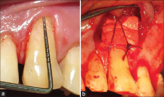 Three-Dimensional Collagen Membranes Challenging the Gold Standard in Gingival Recession.