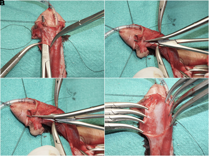 Surgical Technique of Glans Wings Creation with Preservation of Glanular Vascular Arcade and Creating Flaps for Tension-Free Glansplasty in Hypospadias Repair.