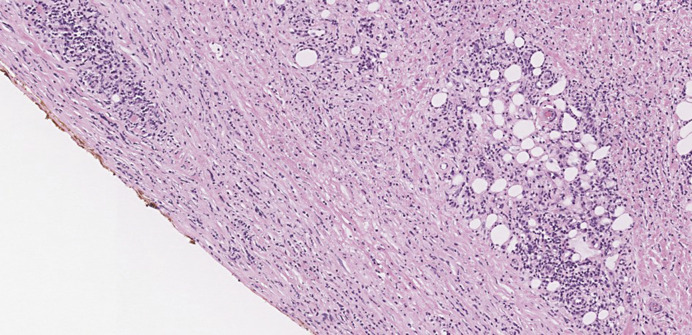 Eosinophilic Fasciitis Presenting as an Ichthyosiform Eruption of the Bilateral Ankles.