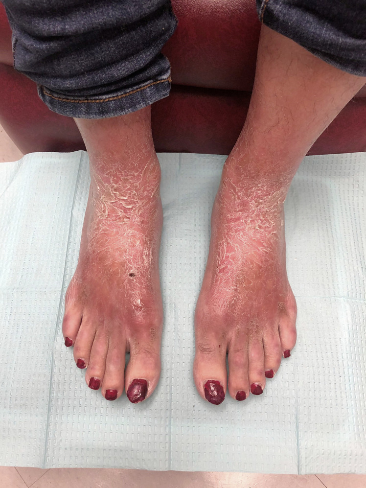 Eosinophilic Fasciitis Presenting as an Ichthyosiform Eruption of the Bilateral Ankles.