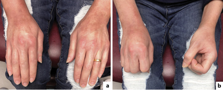 Eosinophilic Fasciitis Presenting as an Ichthyosiform Eruption of the Bilateral Ankles.