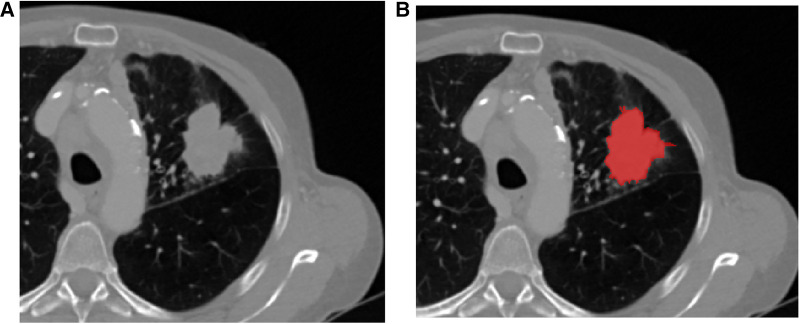 Radiomics combined with transcriptomics to predict response to immunotherapy from patients treated with PD-1/PD-L1 inhibitors for advanced NSCLC.