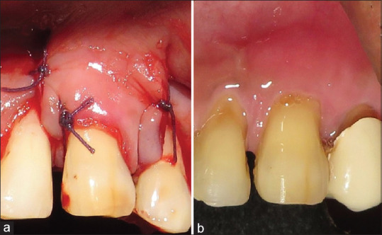 Three-Dimensional Collagen Membranes Challenging the Gold Standard in Gingival Recession.