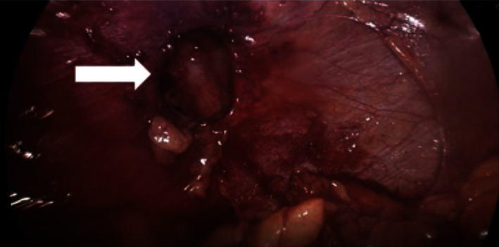 Laparoscopic Repair of Bochdalek Hernia: A Rare Presentation of Abdominal Pain in the Elderly.