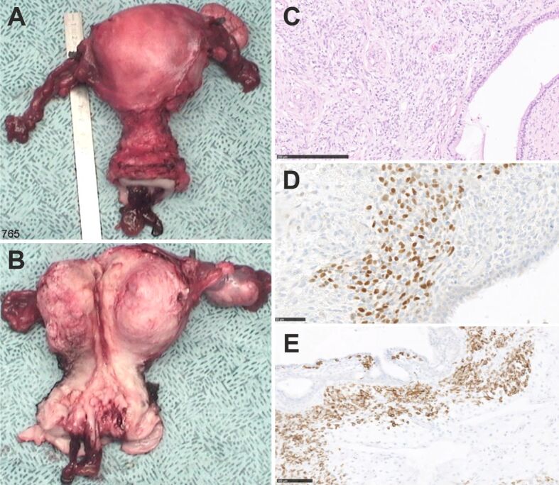 Uterine embryonal rhabdomyosarcoma in adult women: a case report on the challenging diagnosis and treatment.