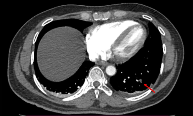 A case of early pulmonary embolism following blunt trauma to chest and a long bone fracture: a case report.