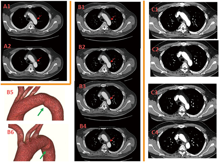 Imaging Study of Acute Limited Intimal Tear.