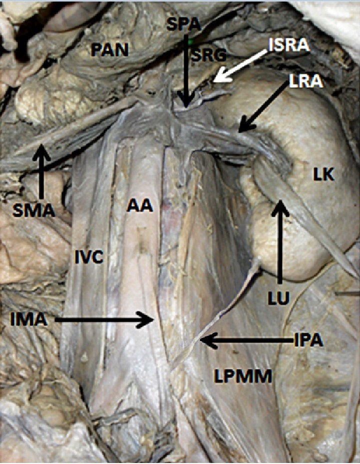 Clinically important left superior polar artery giving rise to a left inferior suprarenal artery and an aberrant left inferior polar artery: a case report.