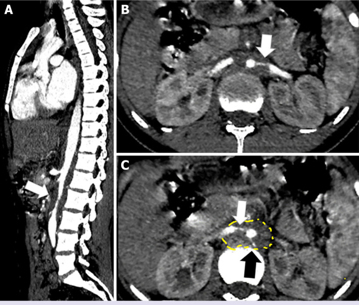 A pediatric case of Takayasu's arteritis with anti-neutrophil cytoplasmic antibody-associated vasculitis triggered by COVID-19 infection.