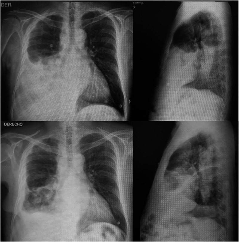 Lymphangitic carcinomatosis as the initial manifestation of primary signet-ring cell adenocarcinoma of the lung: A case report.