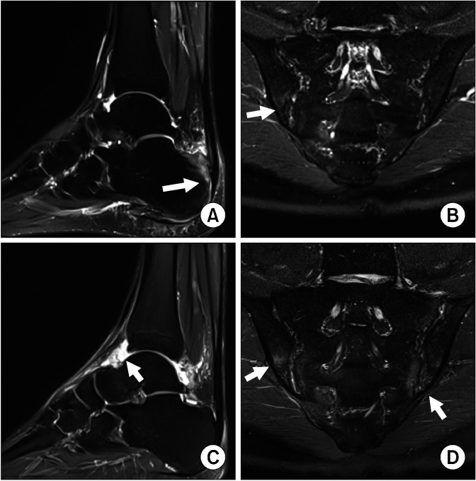 Development of Spondyloarthritis After COVID-19 in HLA-B27-Positive Monozygotic Twins: Case Reports With Single Cell Transcriptome Profiling.