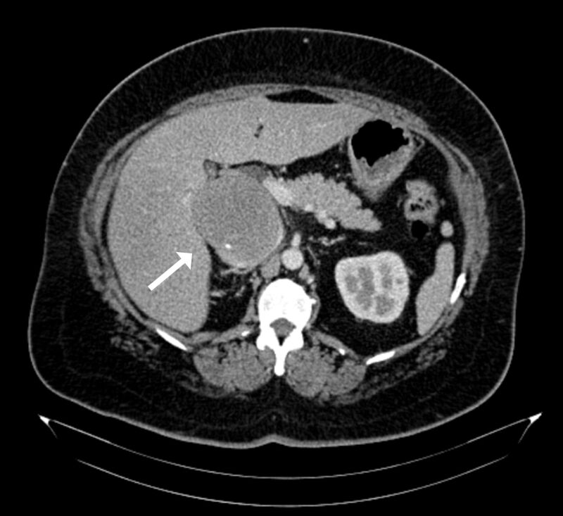 Surgical resection of retrohepatic inferior vena cava leiomyosarcoma without vascular reconstruction: case report.