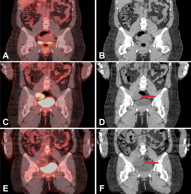 Uterine embryonal rhabdomyosarcoma in adult women: a case report on the challenging diagnosis and treatment.