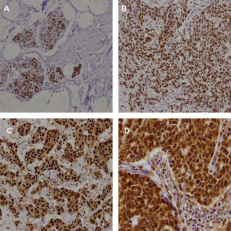 The Prognostic Role of HuR Varies Between Different Subtypes of Breast Cancer Patients: Data Mining and Retrospective Analysis.