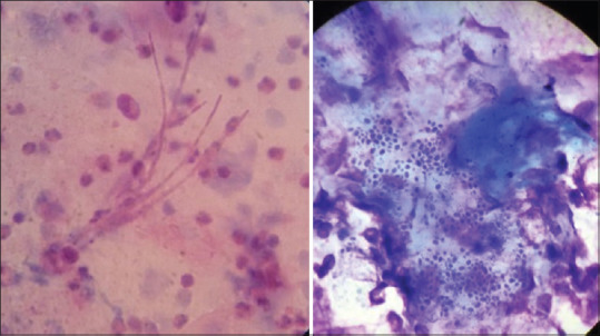 Detection of Opportunistic Fungi from the Bronchoalveolar Lavage Specimens of Patients with Pulmonary Diseases.