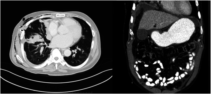 Lymphangitic carcinomatosis as the initial manifestation of primary signet-ring cell adenocarcinoma of the lung: A case report.