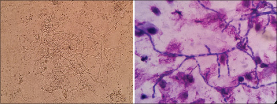 Detection of Opportunistic Fungi from the Bronchoalveolar Lavage Specimens of Patients with Pulmonary Diseases.