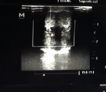 Priapism in a Child from Homocystinuria from Methylenetetrahydrofolate Reductase MTHFR (C677T) Mutation.