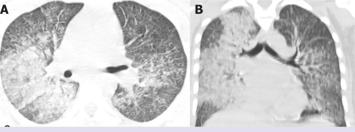 A pediatric case of Takayasu's arteritis with anti-neutrophil cytoplasmic antibody-associated vasculitis triggered by COVID-19 infection.