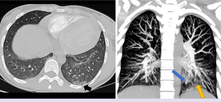 A pediatric case of Takayasu's arteritis with anti-neutrophil cytoplasmic antibody-associated vasculitis triggered by COVID-19 infection.