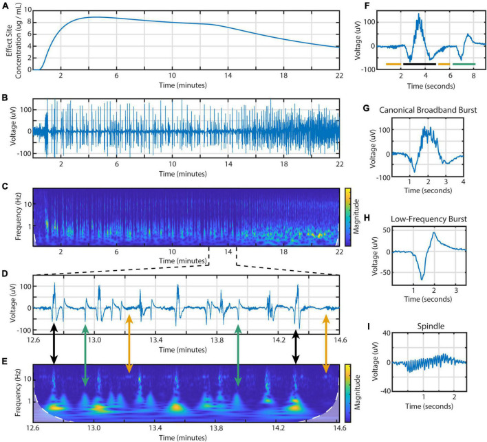 Diversity of electroencephalographic patterns during propofol-induced burst suppression.