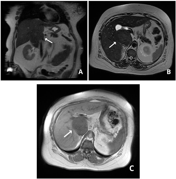 Surgical resection of retrohepatic inferior vena cava leiomyosarcoma without vascular reconstruction: case report.