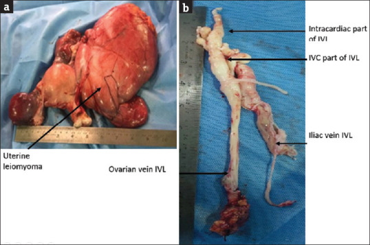 Intracardiac Leiomyomatosis Arising from a Uterine Leiomyoma - A Rare Case Requiring a Multidisciplinary Laparotomy-Thoracotomy Approach.