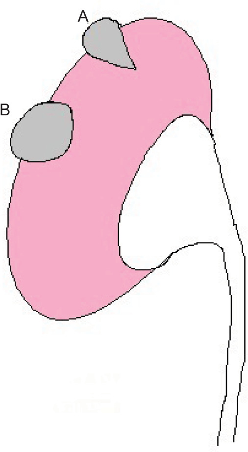 Role of Angular Interface Sign in Characterizing Small Exophytic Renal Masses in Computed Tomography; Prospective Study.