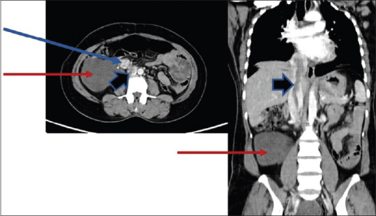 Intracardiac Leiomyomatosis Arising from a Uterine Leiomyoma - A Rare Case Requiring a Multidisciplinary Laparotomy-Thoracotomy Approach.