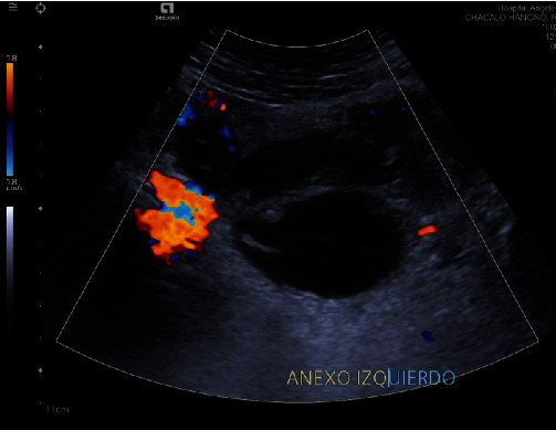 Isolated Fallopian Tube Torsion with Necrotic Hemorrhagic Cyst in an 11-Year-Old Girl Diagnosed by Laparoscopy.