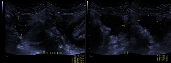 Isolated Fallopian Tube Torsion with Necrotic Hemorrhagic Cyst in an 11-Year-Old Girl Diagnosed by Laparoscopy.