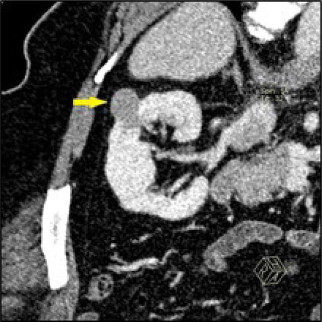 Role of Angular Interface Sign in Characterizing Small Exophytic Renal Masses in Computed Tomography; Prospective Study.