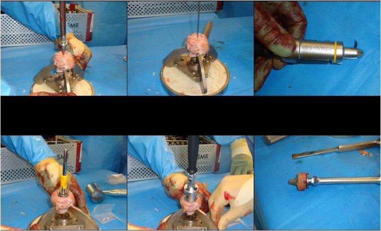 Survivorship of Allologous Structural Bone Graft at a Minimum of 2 Years When Used to Address Significant Glenoid Bone Loss in Revision Shoulder Arthroplasty: A Computed Tomographic and Clinical Review.