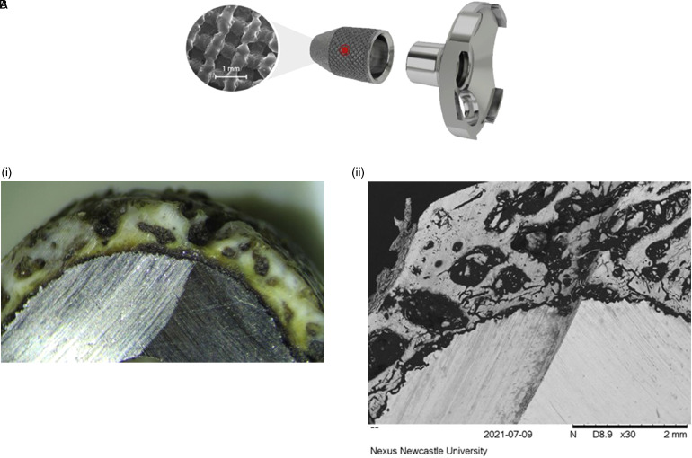 Survivorship of Allologous Structural Bone Graft at a Minimum of 2 Years When Used to Address Significant Glenoid Bone Loss in Revision Shoulder Arthroplasty: A Computed Tomographic and Clinical Review.