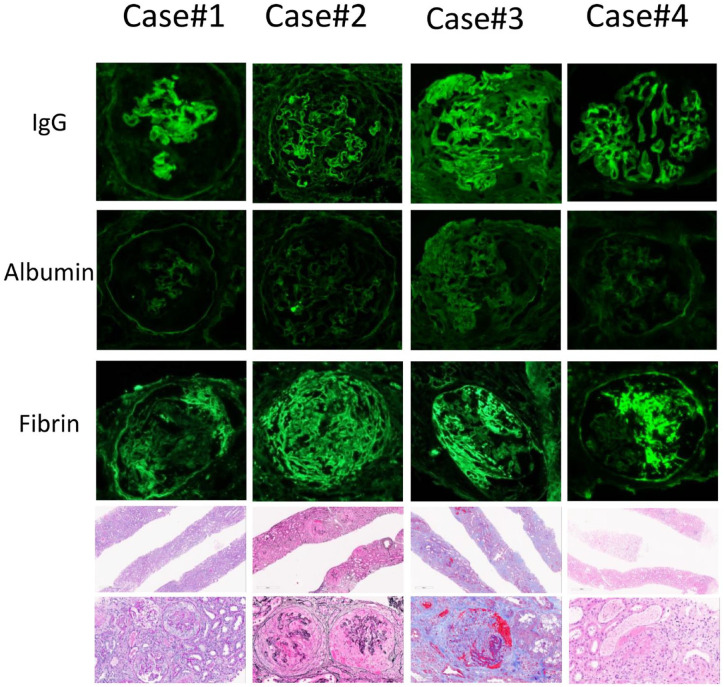 Double-Positive Anti-Glomerular Basement Membrane Antibody and Myeloperoxidase Antineutrophil Cytoplasmic Autoantibody-Associated Glomerulonephritis Post COVID-19 mRNA vaccine: A Case Series of 4 Patients.