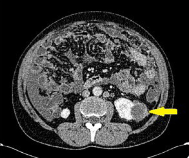 Role of Angular Interface Sign in Characterizing Small Exophytic Renal Masses in Computed Tomography; Prospective Study.