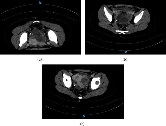 Isolated Fallopian Tube Torsion with Necrotic Hemorrhagic Cyst in an 11-Year-Old Girl Diagnosed by Laparoscopy.