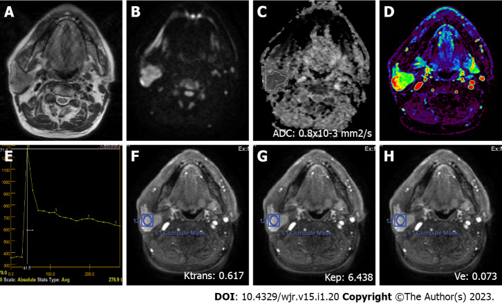 Diagnostic efficacy of diffusion-weighted imaging and semiquantitative and quantitative dynamic contrast-enhanced magnetic resonance imaging in salivary gland tumors.