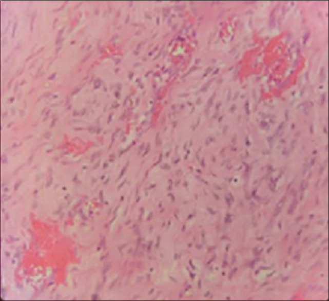 Intracardiac Leiomyomatosis Arising from a Uterine Leiomyoma - A Rare Case Requiring a Multidisciplinary Laparotomy-Thoracotomy Approach.