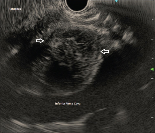 EUS-guided through-the-needle microforceps biopsy for diagnosis of tubercular lymphadenitis mimicking pancreatic cystic lesion (with video).