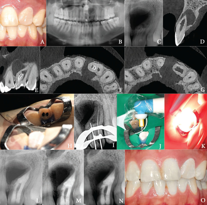 A Successful Non-surgical Management of a Type II Dens Invaginatus with Antimicrobial Photodynamic Therapy: A Case Report.