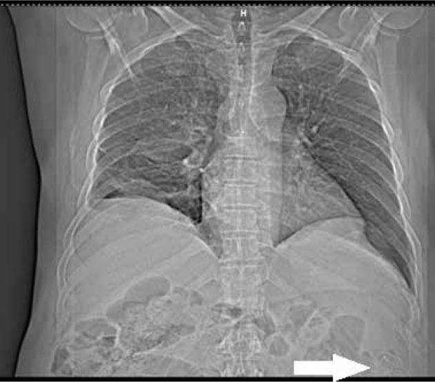 Surgical items retained in the abdominal cavity in diagnostic imaging tests: a series of 10 cases and literature review.