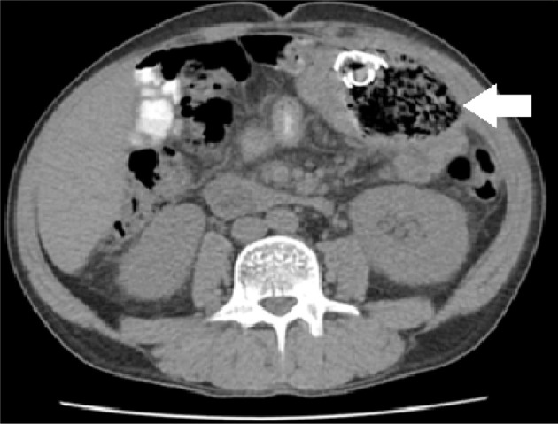 Surgical items retained in the abdominal cavity in diagnostic imaging tests: a series of 10 cases and literature review.