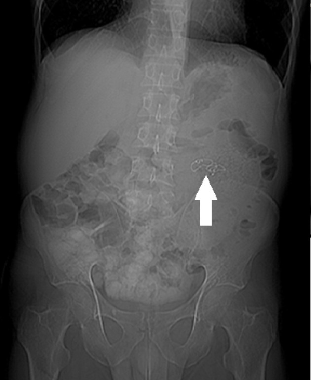 Surgical items retained in the abdominal cavity in diagnostic imaging tests: a series of 10 cases and literature review.